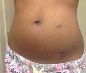 laparoscopic myomectomy scars